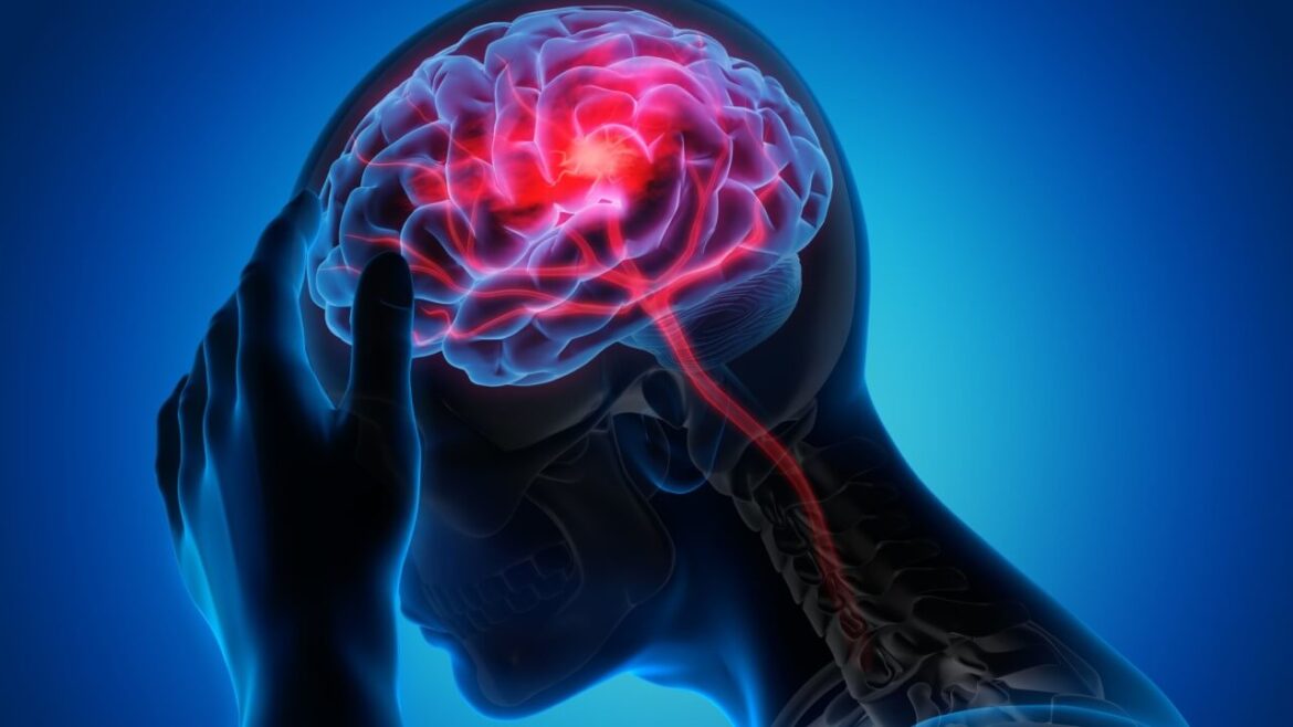 Was Du über einen Schlaganfall wissen musst Schlaganfall: Das musst Du unbedingt wissen