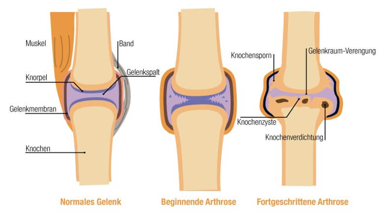 Verlauf einer Arthrose