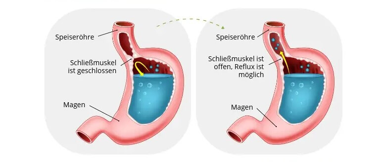 Omas Hausmittel bei Sodbrennen: Ursachen