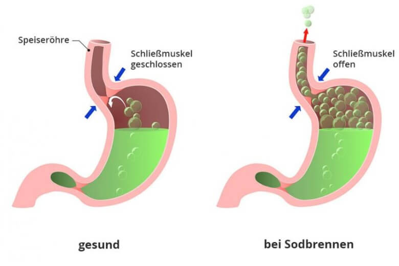 Medikamente gegen Sodbrennen: Entstehung von Sodbrennen