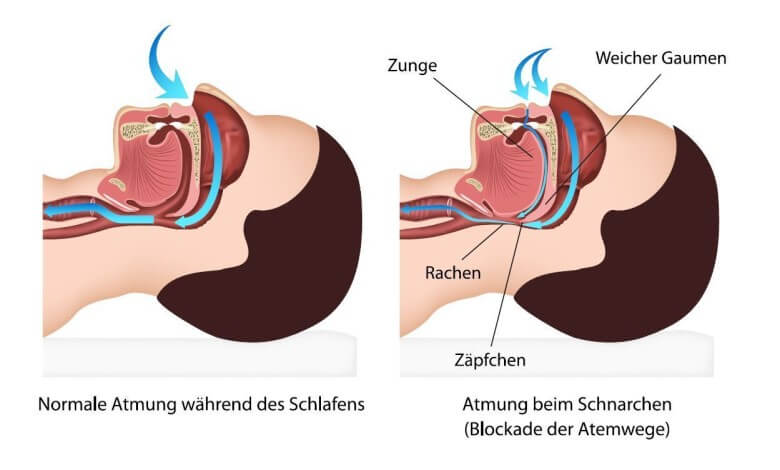 Schnarchen vermeiden: Ursachen