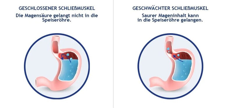 Ursachen von Sodbrennen