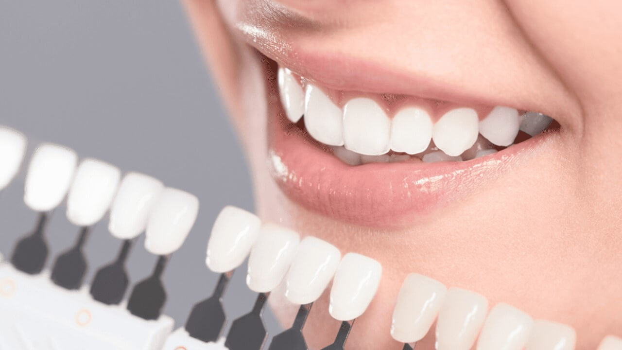 Veneers im Schnellcheck: Wie vorteilhaft sind die Verblendschalen?